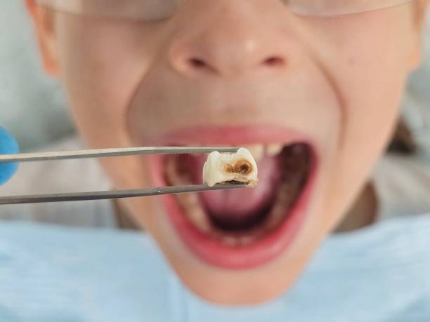 Best Urgent Tooth Repair  in Brilliant, OH